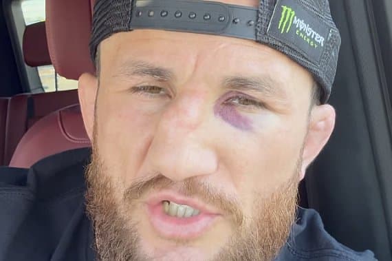Бывший чемпион UFC сломал нос на тренировке и отказался от корректирующей операции